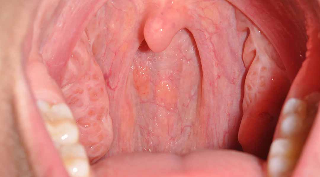 Hóa trị tiêu chuẩn cho ung thư cổ họng HPV vẫn là hiệu quả nhất