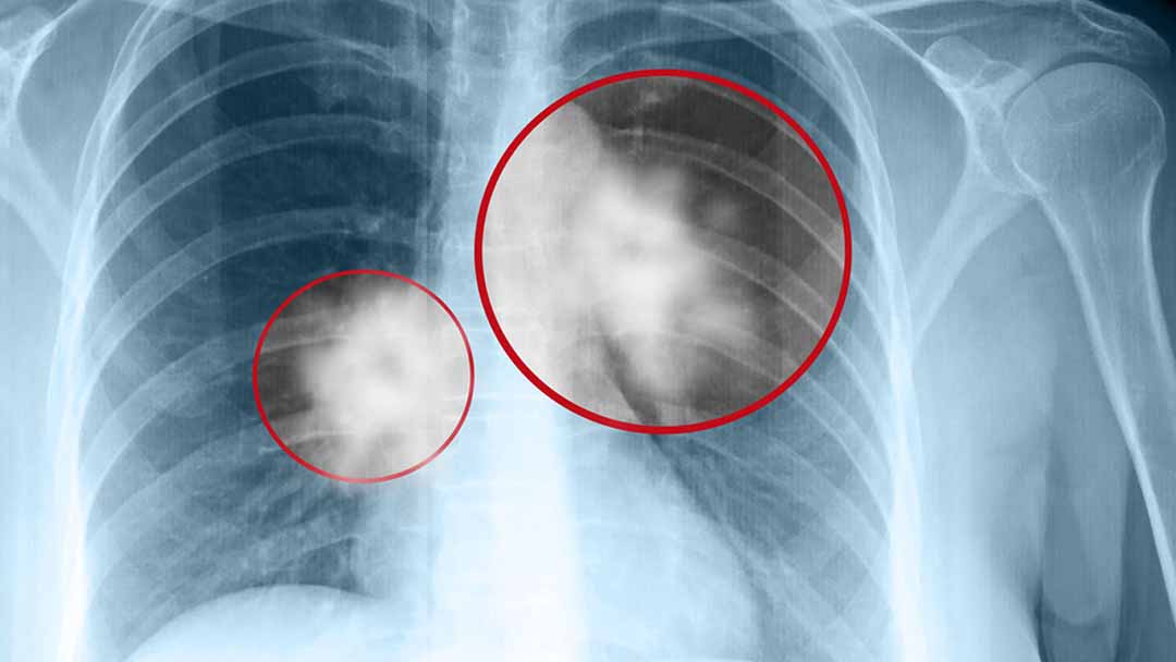 Liệu pháp miễn dịch gây ra phản ứng phụ phổ biến trong điều trị ung thư NSCLC