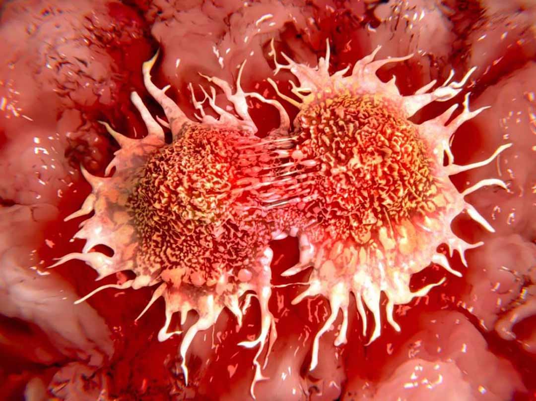 RIP1 Kinase là mục tiêu điều trị nhiều triển vọng trong ung thư tuyến tụy