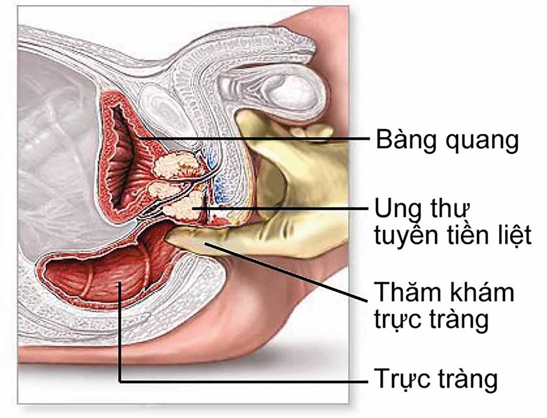 Tránh tác dụng phụ trong quá trình điều trị ung thư tuyến tiền liệt .