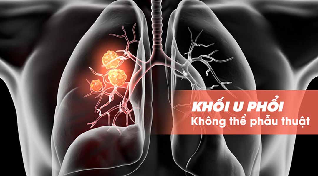 Khối u phổi không thể phẫu thuật