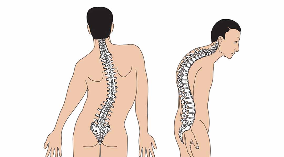 Triệu chứng thường là vẹo cột sóng, xương dễ gãy hay cao huyết áp.