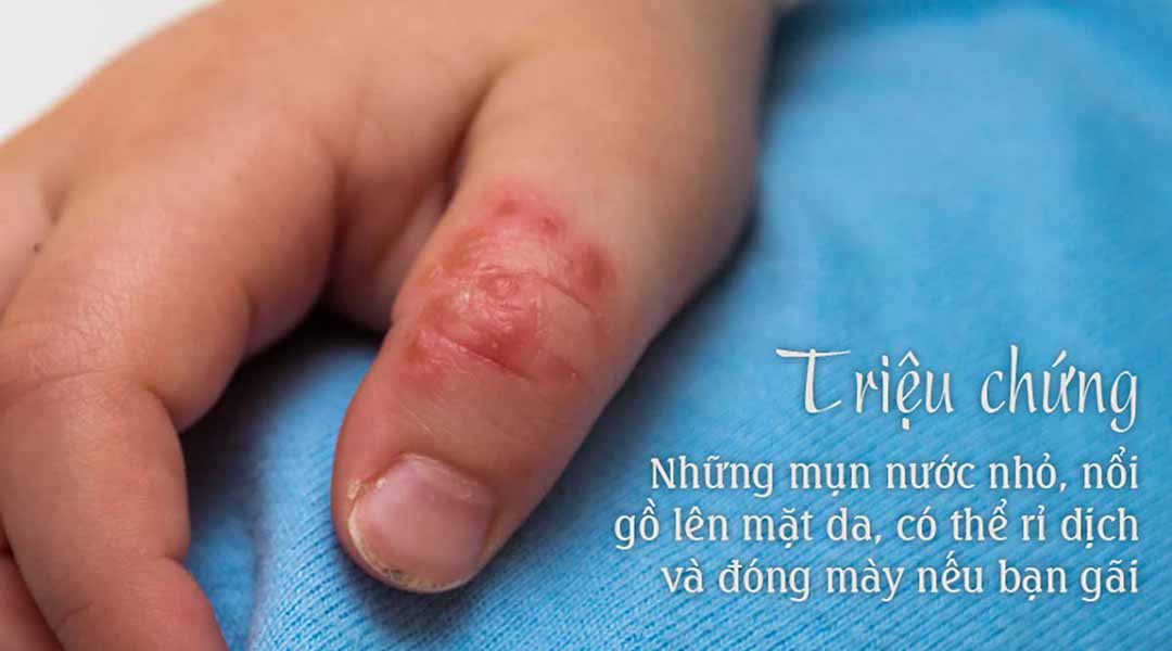 Bệnh Chàm có các dấu hiệu và triệu chứng khá đa dạng, tùy thuộc tình trạng mỗi người bệnh.