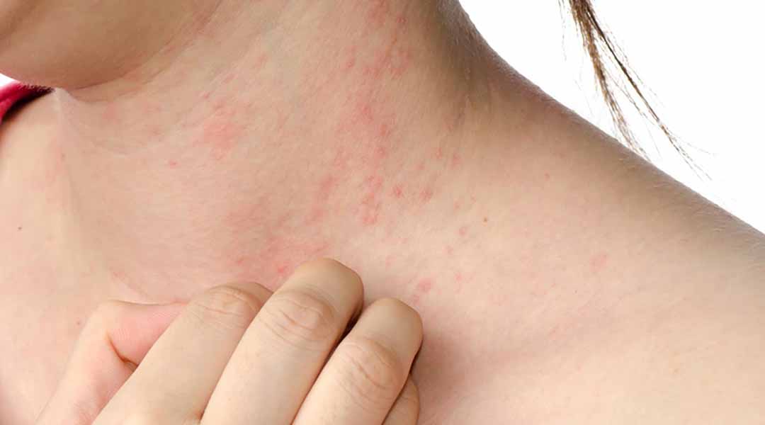 Vàng da và ngứa da là một trong các triệu chứng.