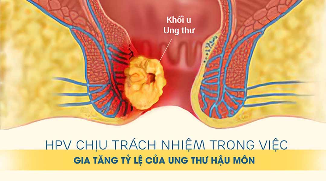 HPV chịu trách nhiệm trong việc gia tăng tỷ lệ của ung thư hậu môn