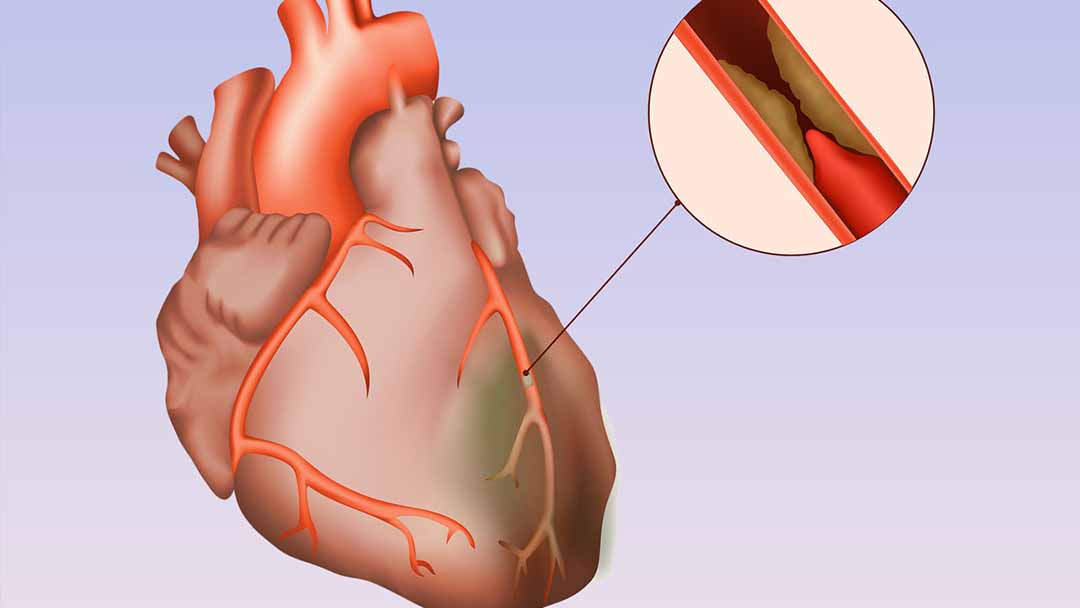 Thiếu máu não được coi là hội chứng bệnh lý có nguy cơ gây tử vong thứ 3 trên thế giới.