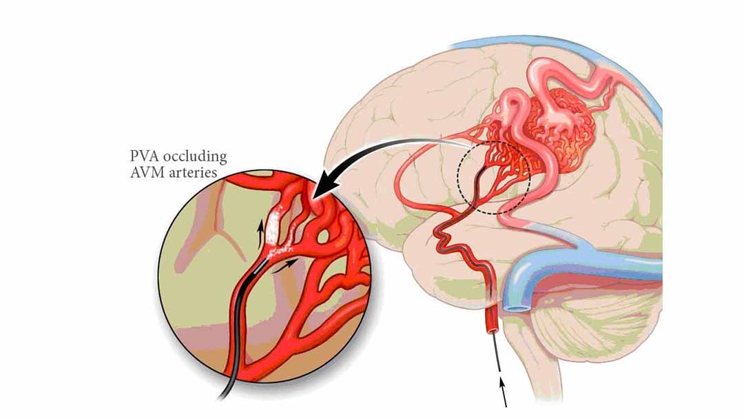 Dị dạng mạch máu não có thể được chẩn đoán qua chụp cộng hưởng từ não (chụp MRI não).