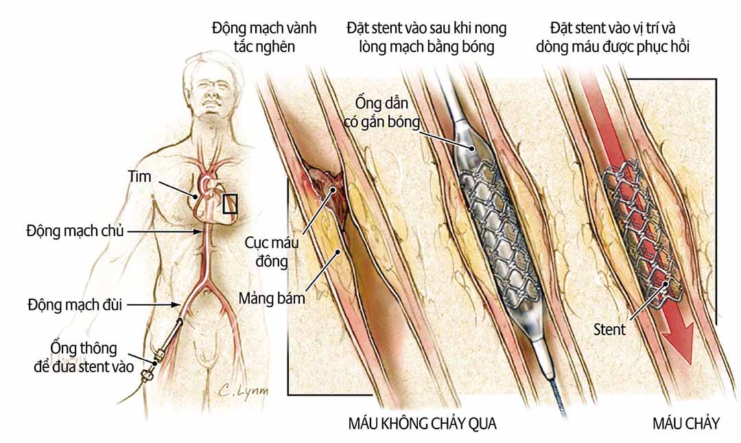 Bệnh nhân ung thư có nguy cơ biến chứng cao hơn sau khi thủ thuật tim.