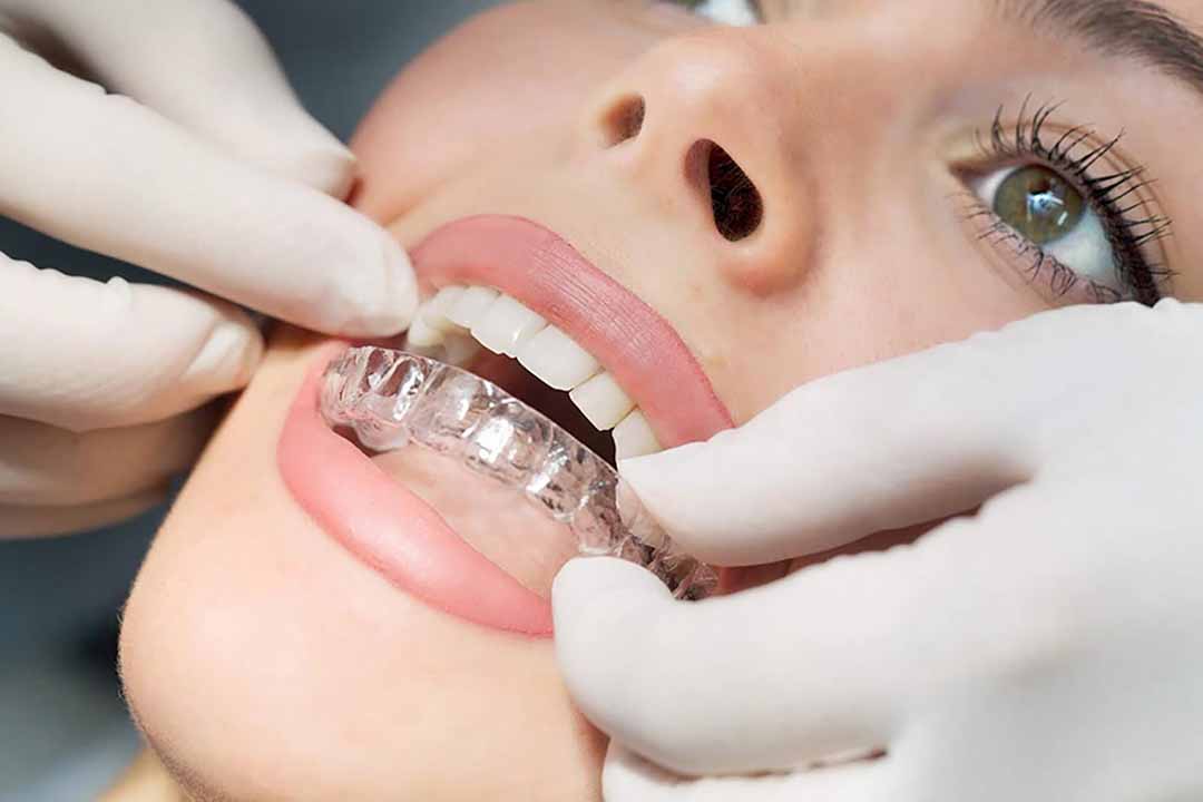 Công nghệ niềng răng Invisalign không gây mất tự tin