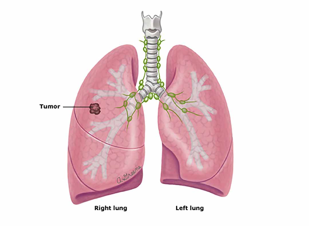 Điều trị ung thư phổi tế bào nhỏ