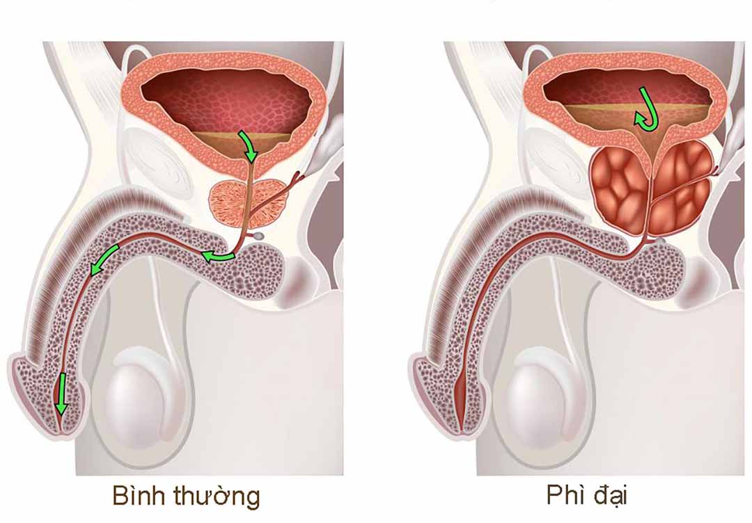 Phì đại tuyến tiền liệt là nguyên nhân chính gây tiểu đêm ở nam giới cao tuổi.