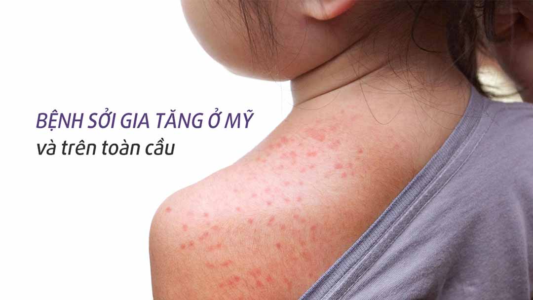 Các trường hợp bệnh sởi gia tăng ở Mỹ và trên toàn cầu