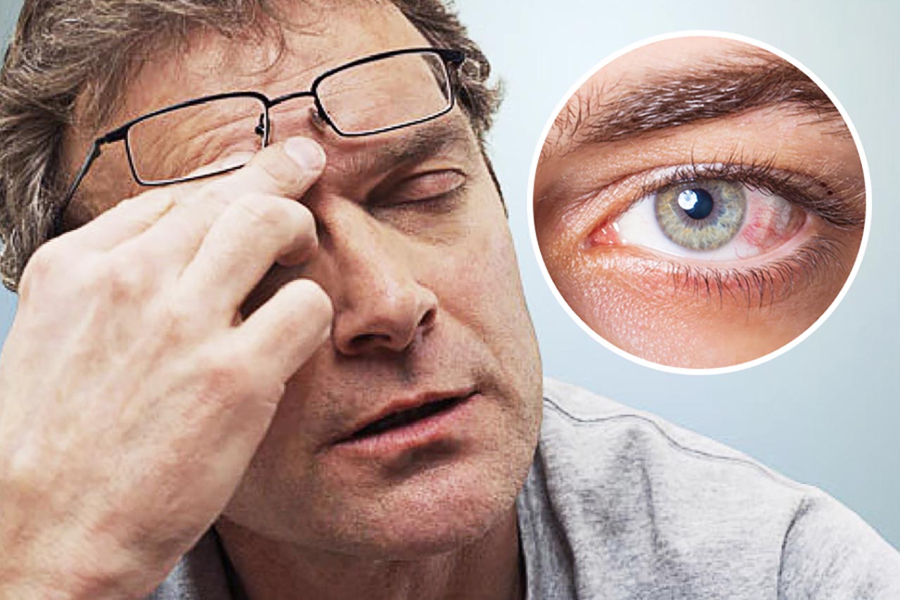 Chứng khô mắt khi nào thì nguy hiểm?