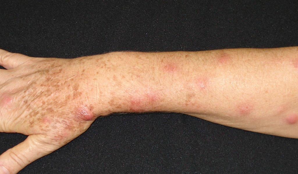 Bệnh nấm Sporotrichosis