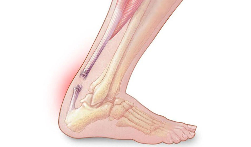 Đứt gân Achilles(gót chân)