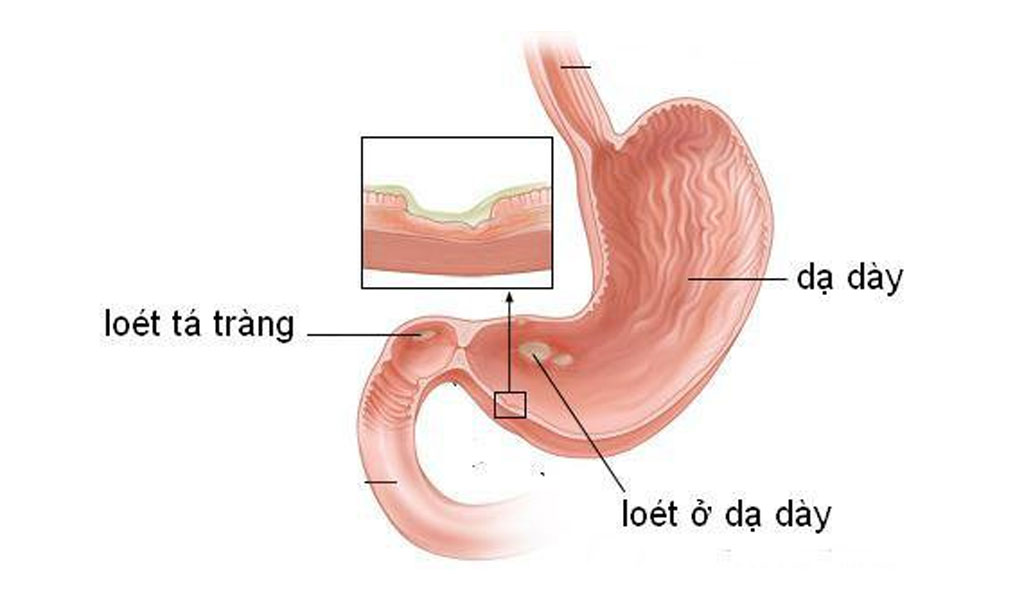 Loét dạ dày