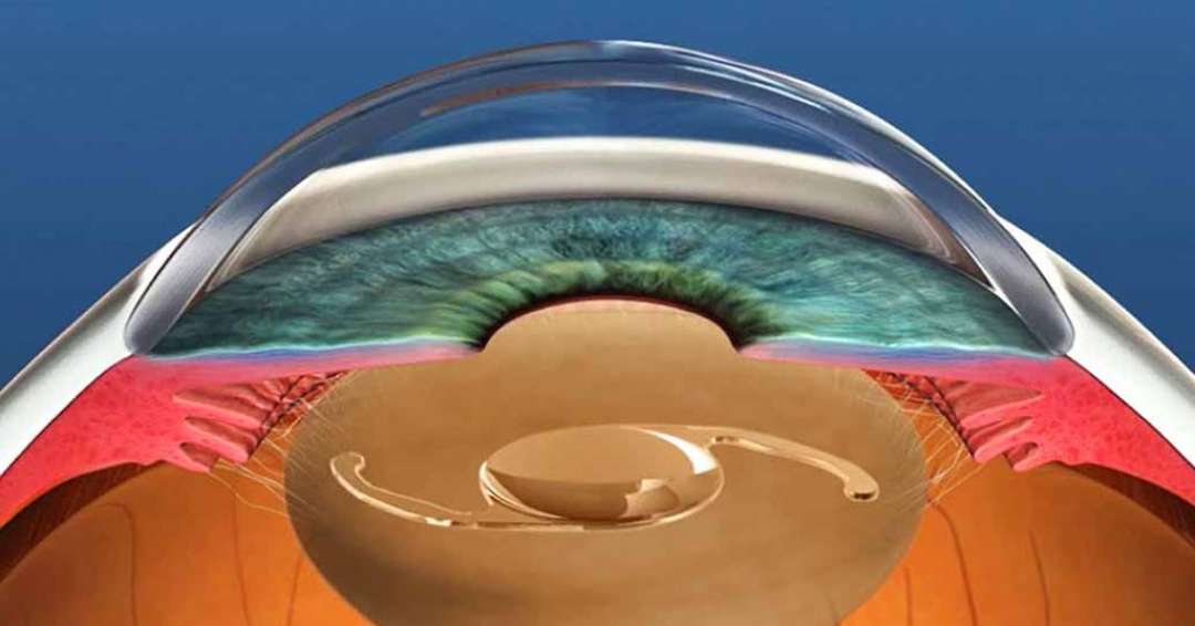 Больница операция глаукомы. Селективная лазерная трабекулопластика. Узкоугольная глаукома. Аргон лазерная трабекулопластика. Селективная лазерная трабекулопластика глаза.