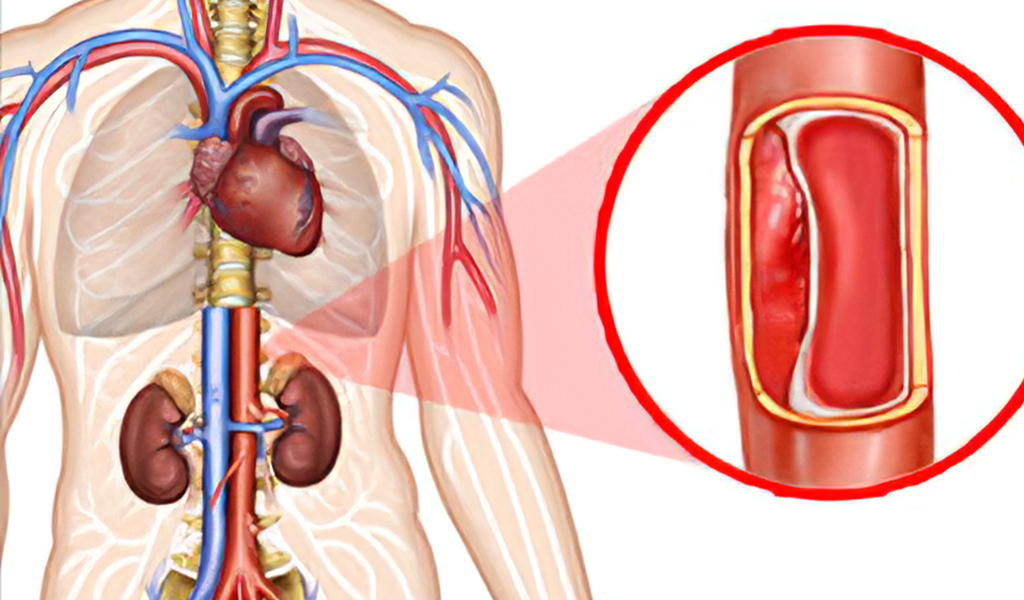 Bóc tách động mạch chủ (bụng)