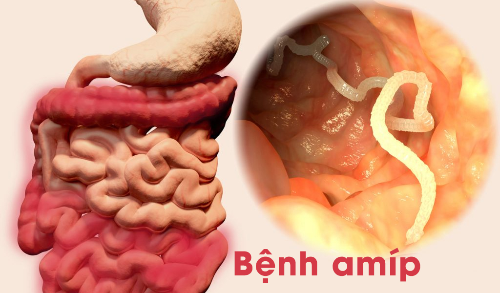 Bệnh amíp