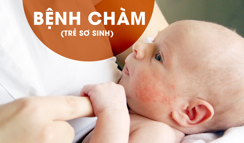Bệnh chàm (trẻ sơ sinh)