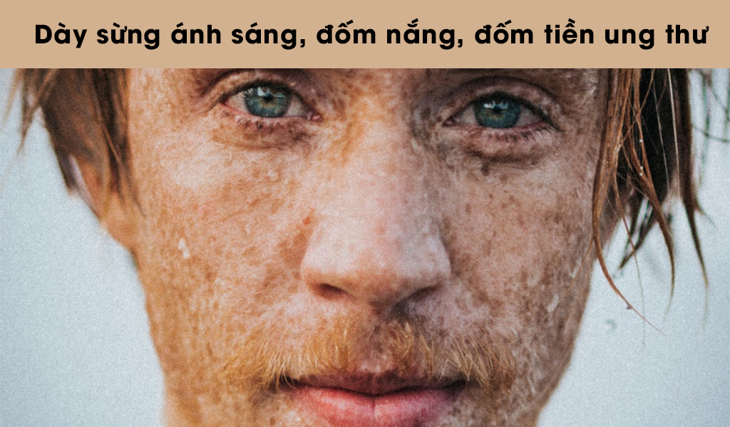 Bệnh dày sừng quang hóa