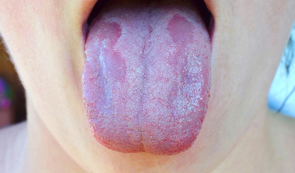 Bệnh tưa miệng (trẻ sơ sinh và trẻ em)