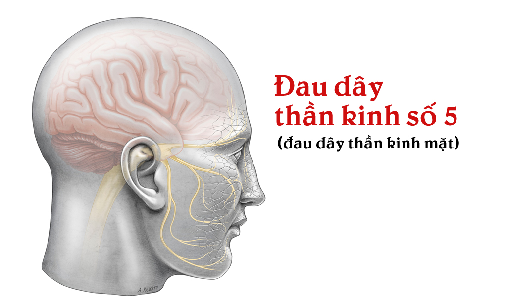 Đau dây thần kinh số 5 (đau dây thần kinh mặt)