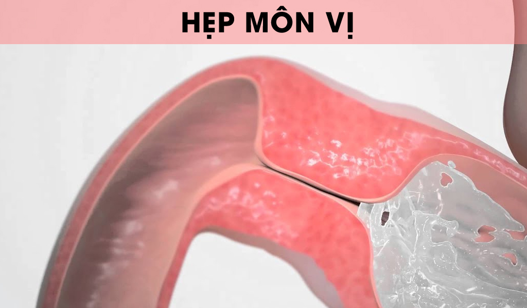 Hẹp môn vị