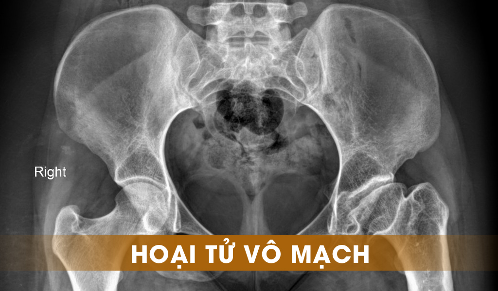 Hoại tử vô mạch
