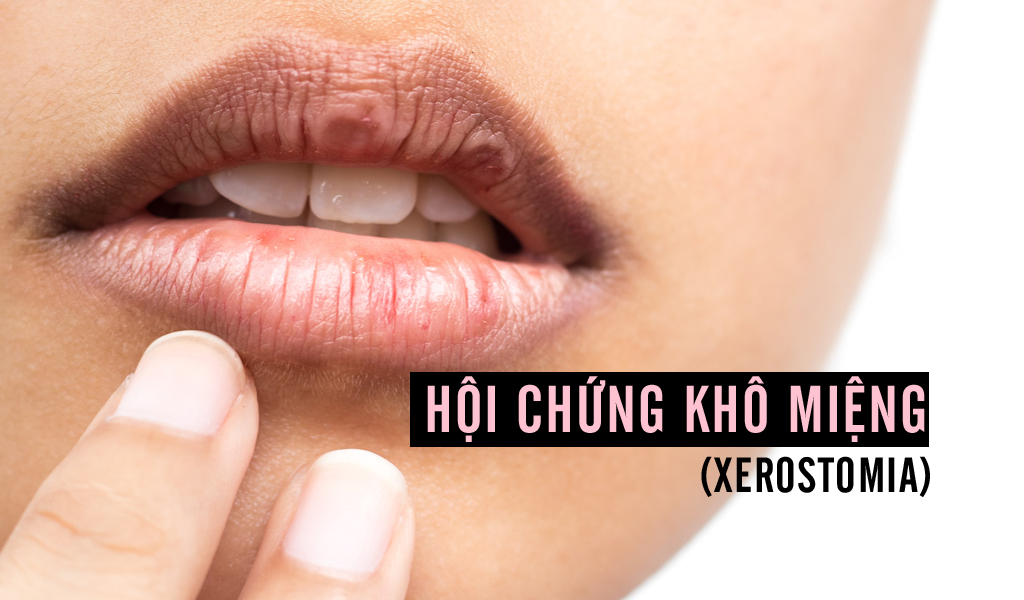 Hội chứng khô miệng (xerostomia)