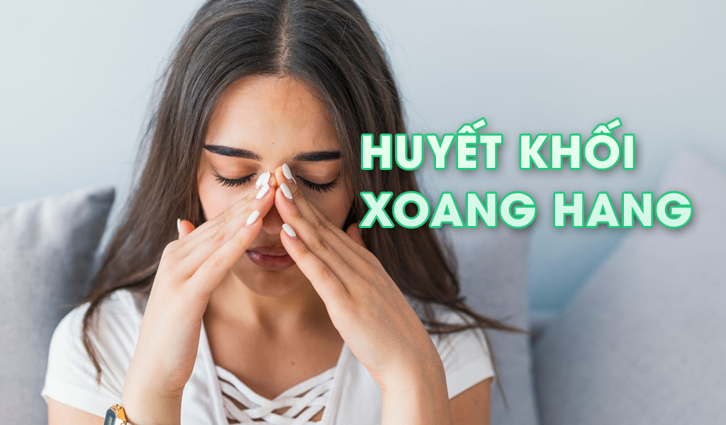 Huyết khối xoang hang