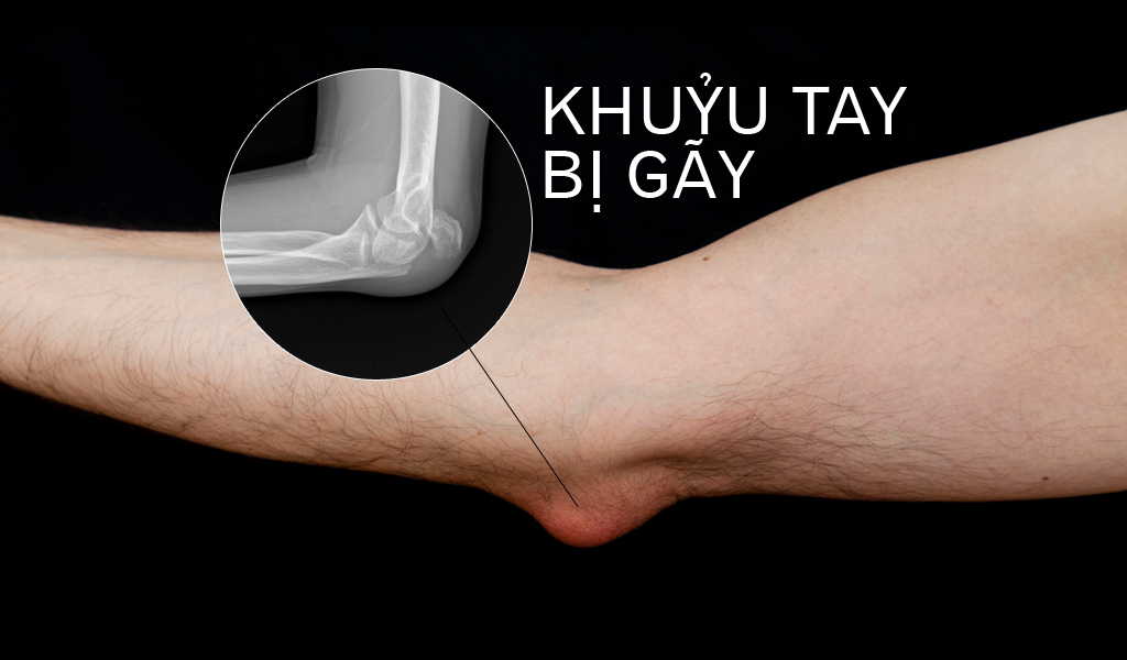 Khuỷu tay bị gãy