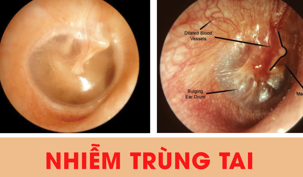 Nhiễm trùng tai