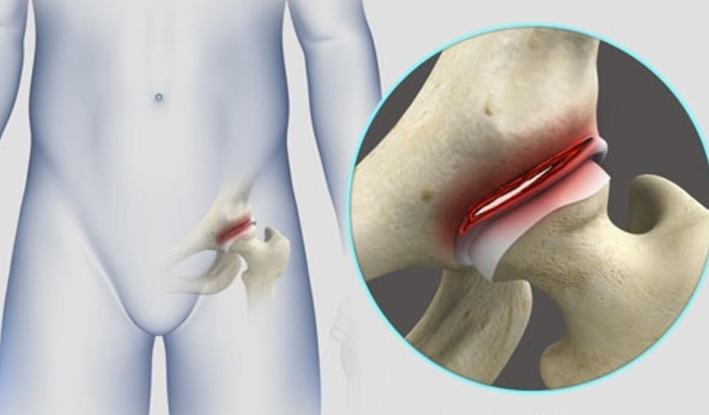 Rách vòng sụn (acetabular) hông