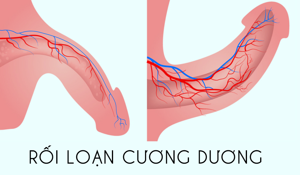 Rối loạn cương dương