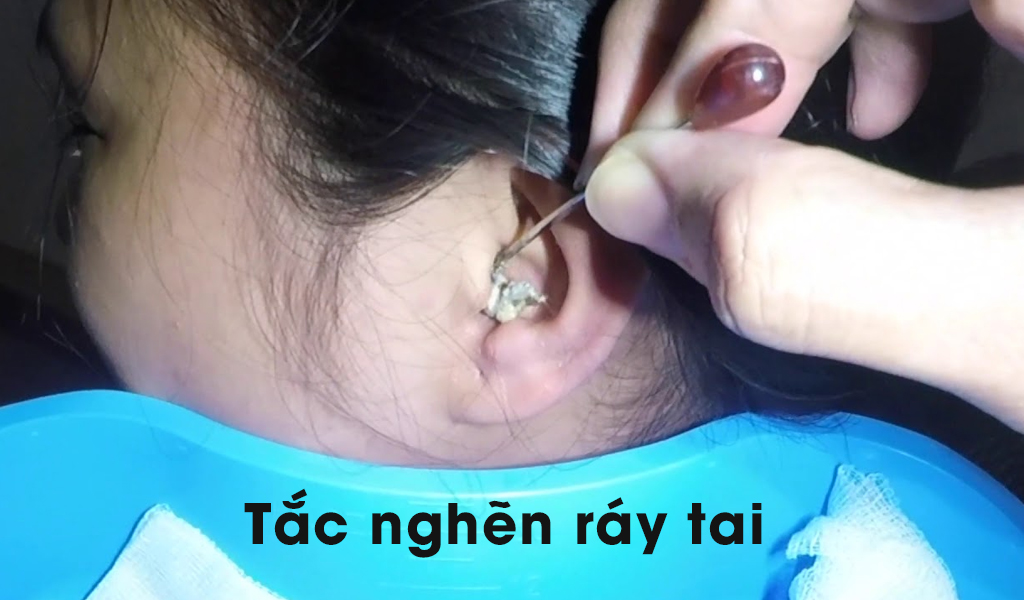 Tắc nghẽn ráy tai