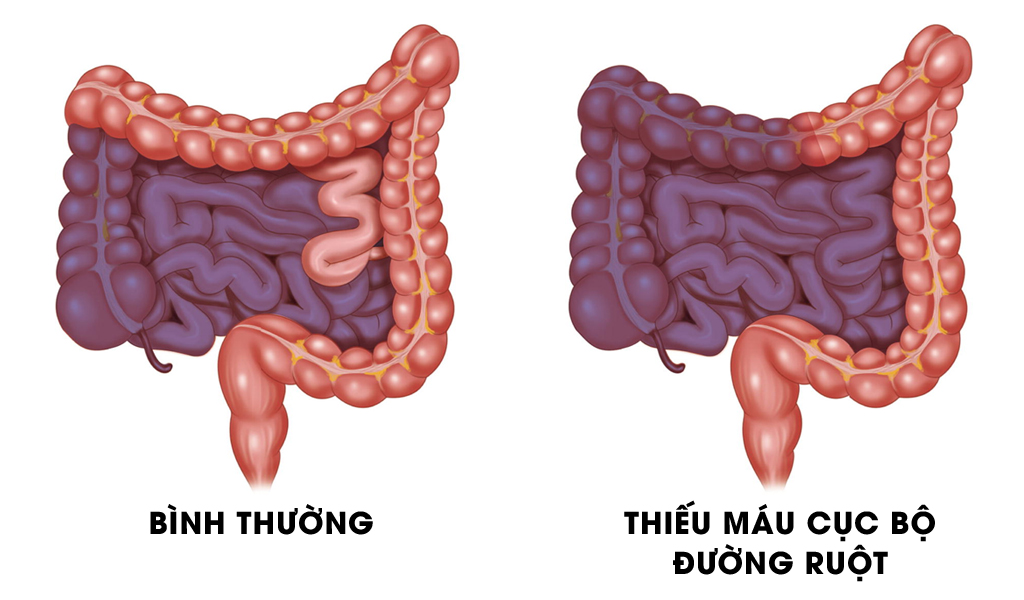 Thiếu máu cục bộ đường ruột