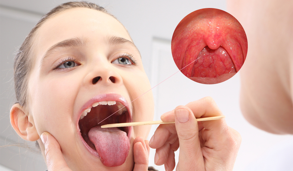 Viêm họng liên cầu khuẩn
