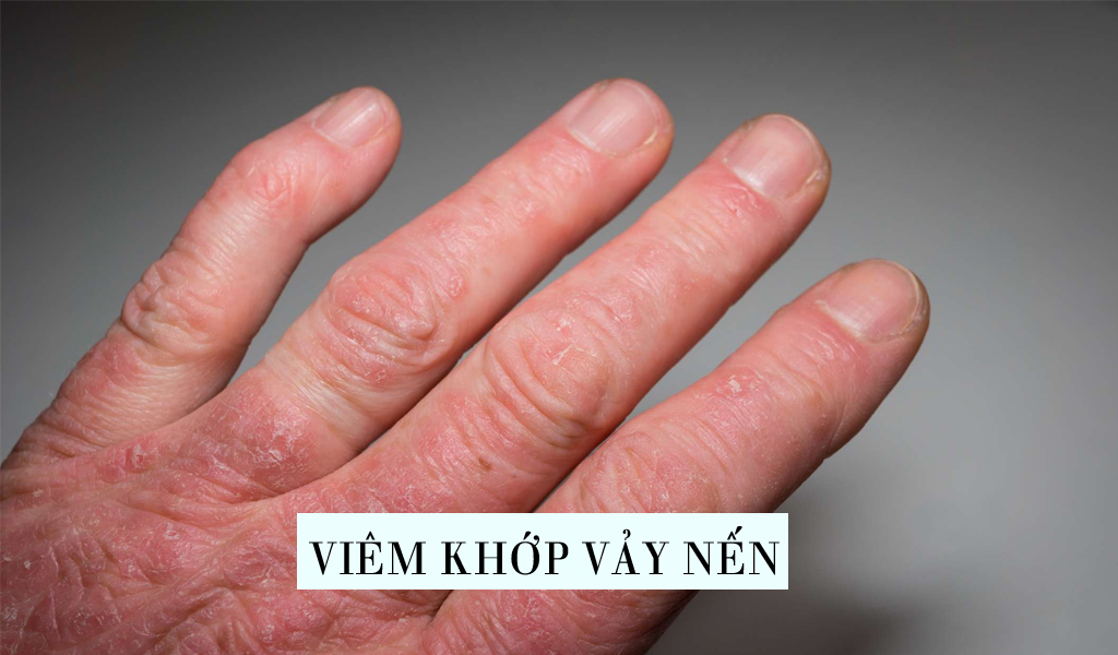 Viêm khớp vảy nến