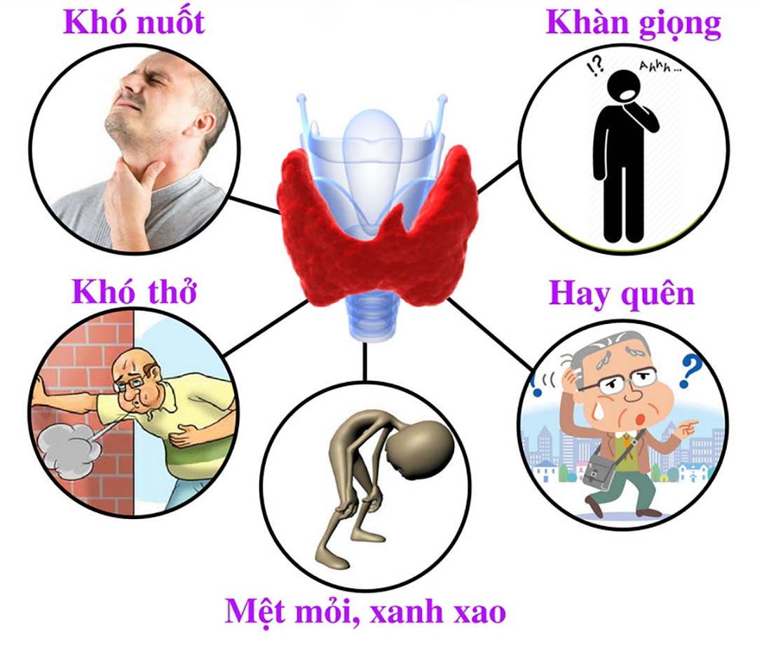 Triệu chứng rõ rệt của bệnh bướu cổ.