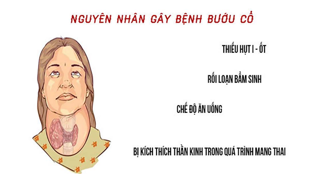 Các nguyên nhân dẫn đến bệnh bướu cổ.