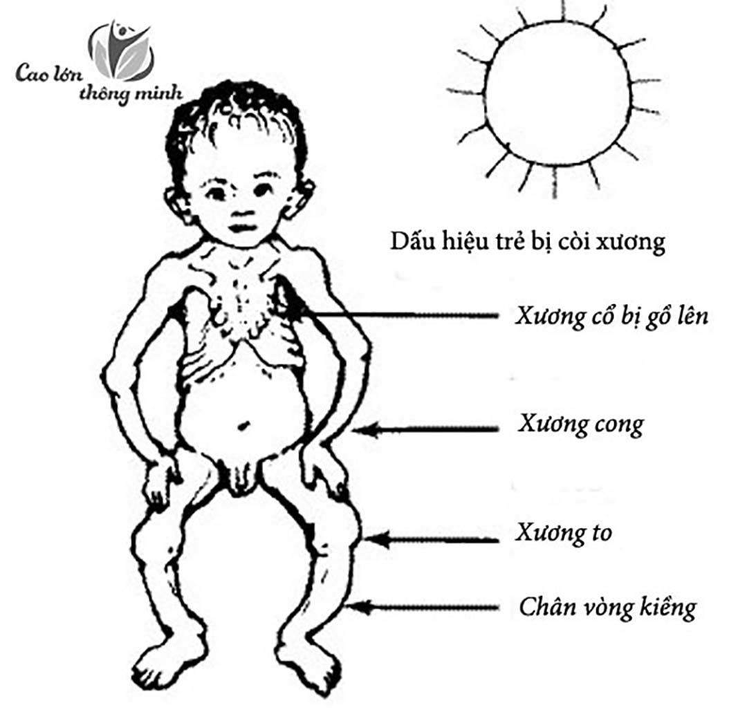 Các dấu hiệu cho thấy trẻ bị còi xương.