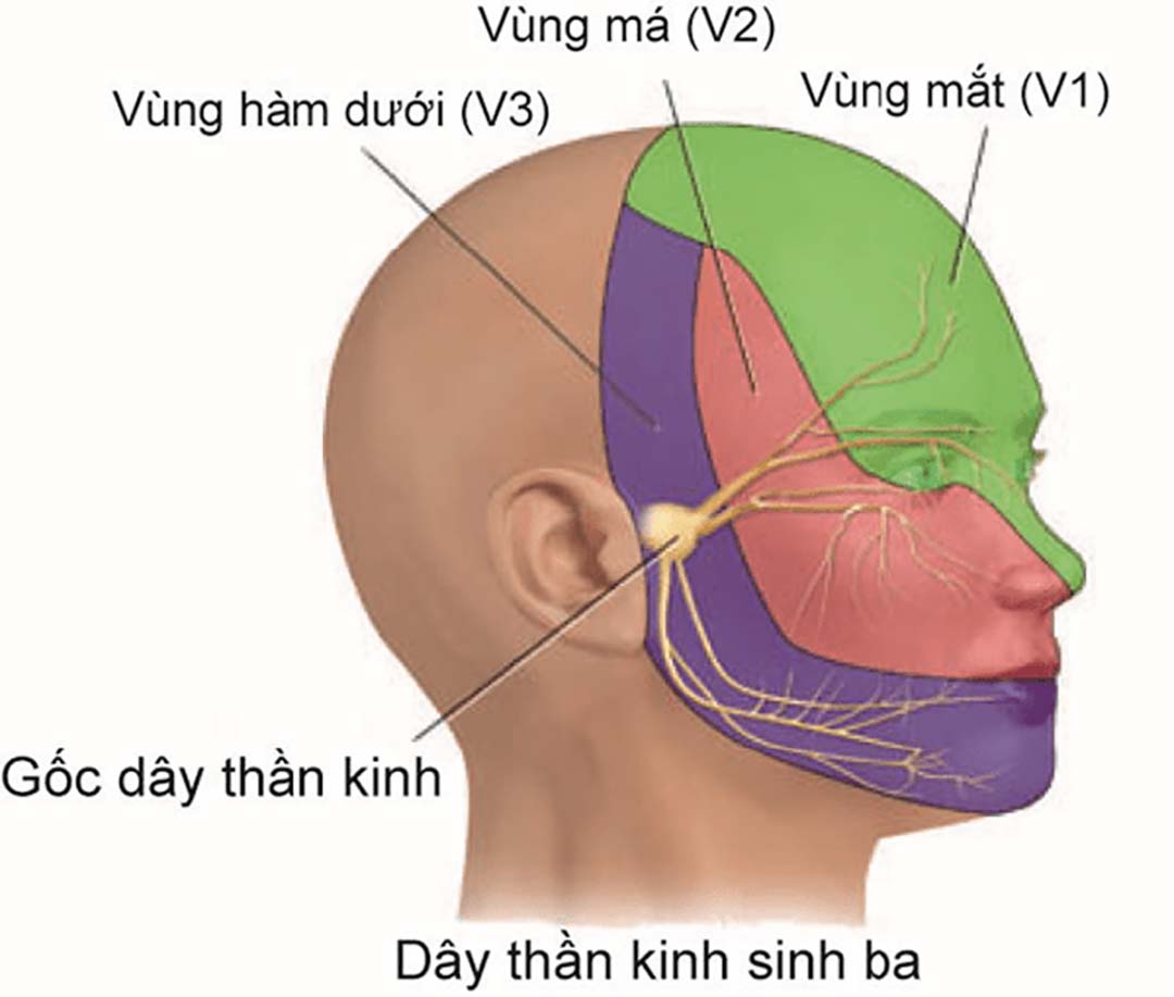 Đau dây thần kinh số V bao gồm vùng: Mắt, má và hàm dưới. 