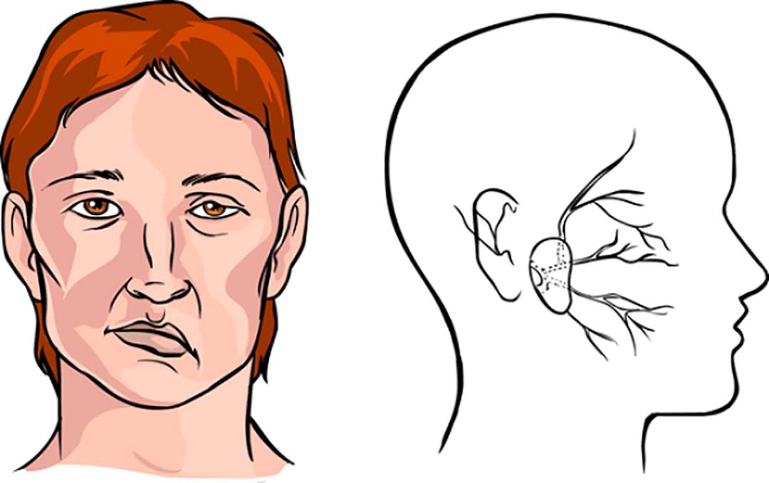 Khuôn mặt của người mắc bệnh liệt mặt.