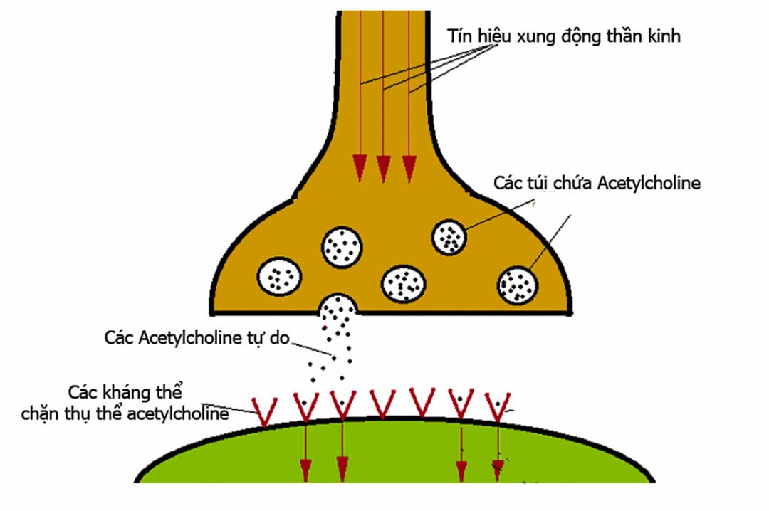 Nhược cơ là một căn bệnh tự miễn