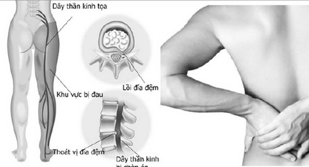 Chú thích nơi bị đau dây thần kinh tọa là như thế nào.