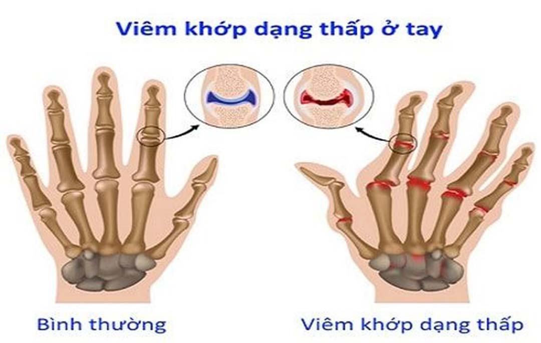 Bàn tay bị biến dạng khi bị viêm khớp dạng thấp hay thấp khop81.